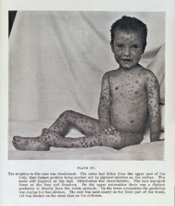 天然痘、病気、パンデミック
